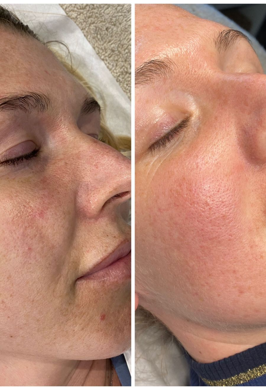 microneeding-before-after.jpeg